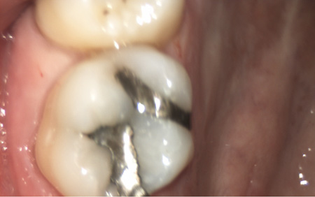 amalgam in tooth