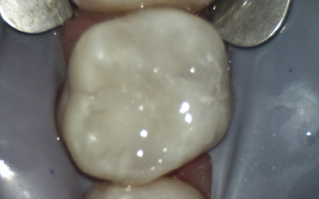 amalgam in tooth gone