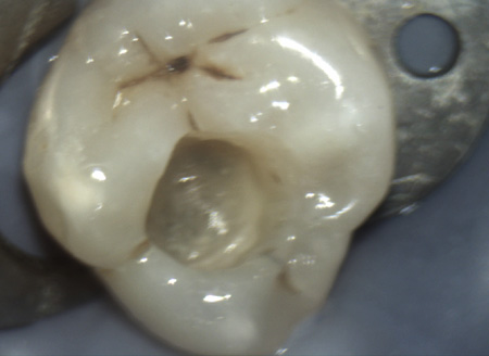amalgam in tooth